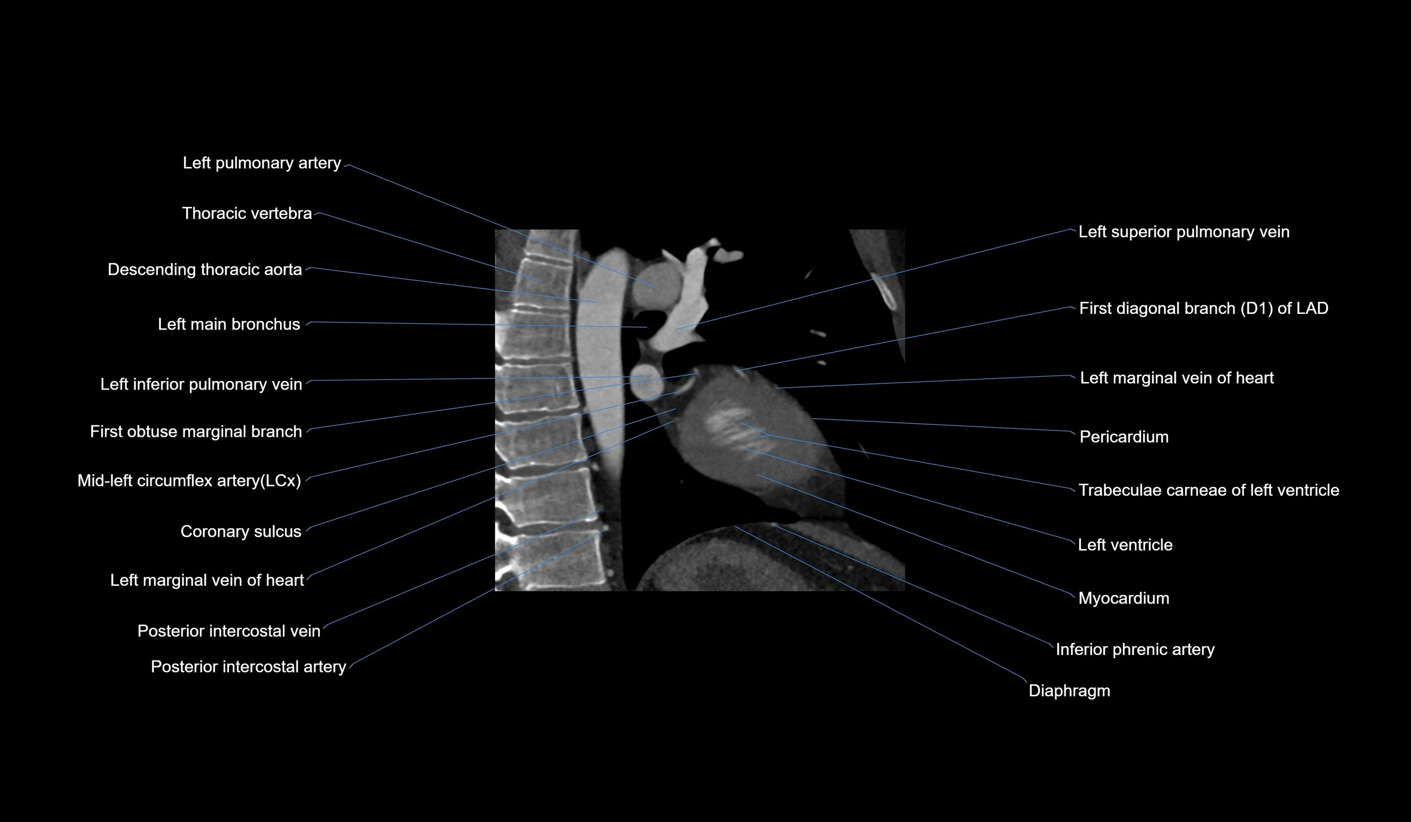 CT heart (coronary angiogram) 2 chamber view cross sectional anatomy labelled radiology image-00006.webp